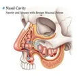 Nasal Polyps