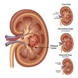 Renal Cancer