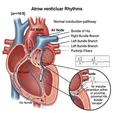 Junctional Escape Rhythm