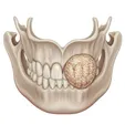 Dental Implant Restoration