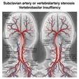 Vertebrobasilar Steal Syndrome