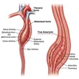True Aortic Aneurysm
