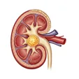 Clear Cell Renal Carcinoma