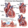 Pulmonary Valve Insufficiency