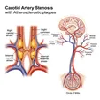 Carotid Artery Stenosis