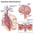 Subclavian Steal Syndrome