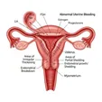 Endometrial Ablation