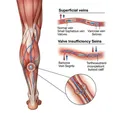 Varicose Veins