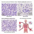 Lymphocytic Leukemia