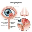 Dacryocystitis