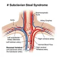 Carotid Steal Syndrome