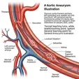 Aortic Aneurysm