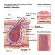 Hemangioma