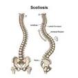 Scoliosis