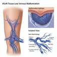 Venous Malformation