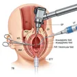 Supraglottoplasty