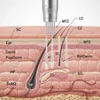 CO₂ Fractional/Ablative Laser