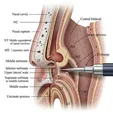 FESS Cyst Fenestration