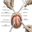 Adult Circumcision