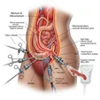 Laparoscopic TME