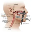 Esophageal Stent Placement