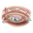 Gold/Platinum Weight Implantation
