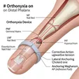 Corrective Band/Nail Groove Splint