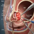 Endoscopic Nasopharyngeal Tumor Resection (Recurrent/Residual Lesion)