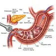 Endoscopic Ultrasound (EUS) for Polyp Risk Assessment