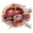 Marsupialization for Radicular Cyst