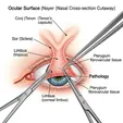 Excision + Amniotic Membrane Transplantation