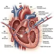 Catheter Ablation