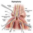 Septoplasty