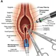 Microlaryngoscopic Vocal Cord Polyp Excision (Cold Instruments/CO₂/KTP)