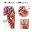 Transcatheter Aortic Valve Replacement (TAVR/TAVI)