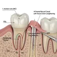 Crown Lengthening