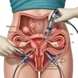 Laparoscopic Strassman Metroplasty