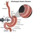 Endoscopic Sleeve Gastroplasty (ESG)