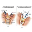 Endoscopic Unilateral Biportal Decompression (UBE/ULBD)
