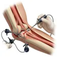 Elbow Arthroscopy Debridement/Cleanup/Loose Body Removal