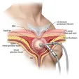 Gland Excision + Liposuction Contouring