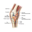 Arthroscopic Internal Impingement Treatment + Meniscus Repair