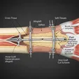 Bone Defect Reconstruction (Masquelet/Ilizarov)