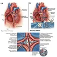 Mitral Valve Repair