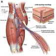 Limb-Sparing Resection and Reconstruction for Sarcoma