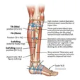 Ilizarov Bone Transport