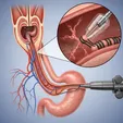 Esophageal Variceal Ligation (EVL)