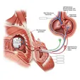 Permanent Pacemaker Implantation (PPM)