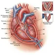 Surgical Pulmonary Valve Replacement