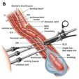 Laparoscopic Meckel's Diverticulectomy